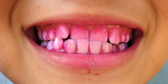 disclose-teeth-700